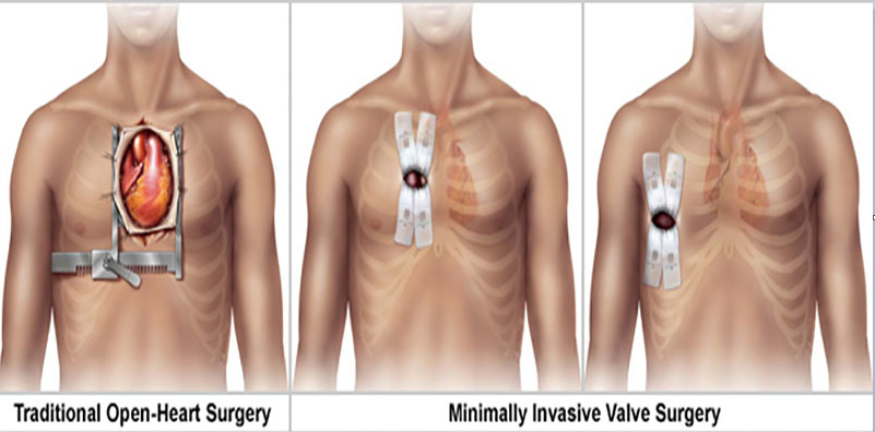 Valve mitrale - INCCI